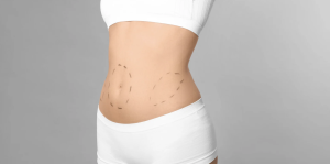 Compare Liposuction Costs in Fairfax VA